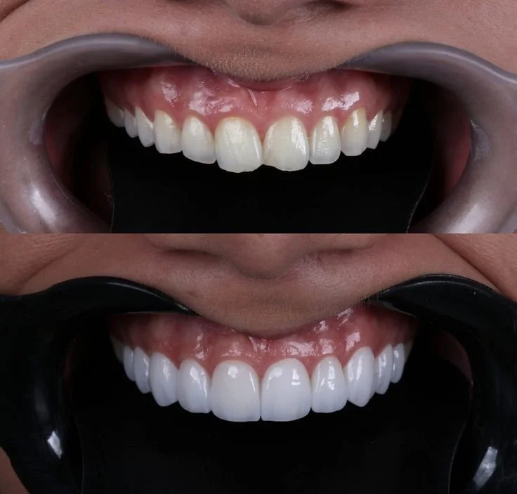 Before and after dental treatment, teeth whitening