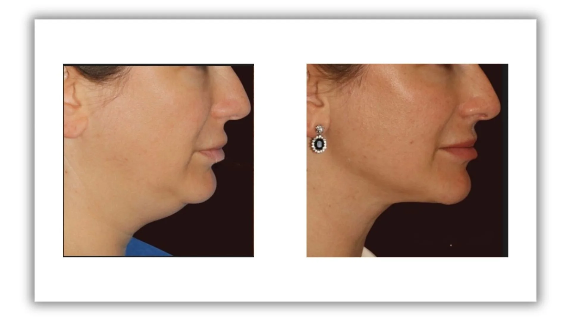 LipoPapada con Láser 360