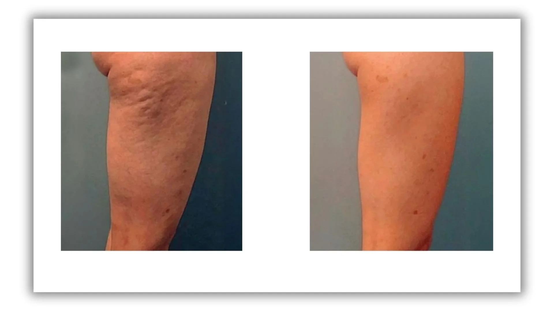 LipoEscultura de piernas 360