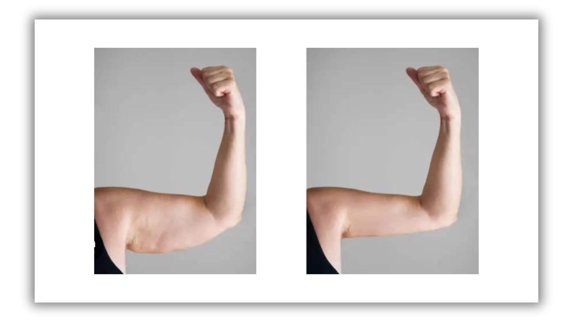 LipoEscultura de brazos 360