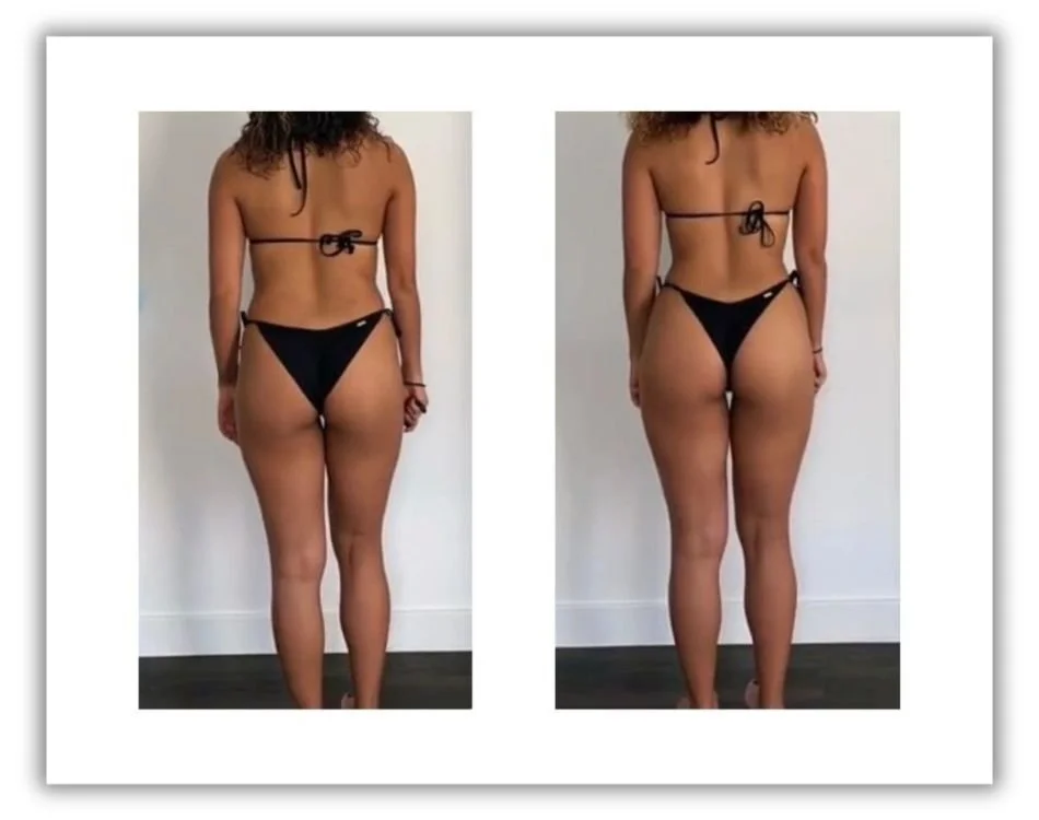 Lipo con Láser 360 con transfer