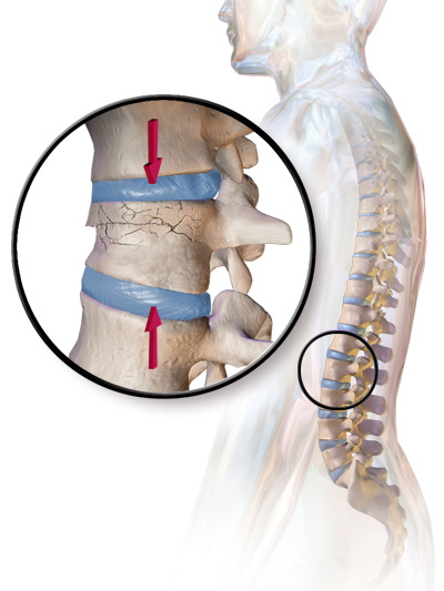 Understanding Compression Fractures & Kyphoplasty