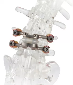 Understanding TOPS: A New Option for Back Pain & Spondylolisthesis