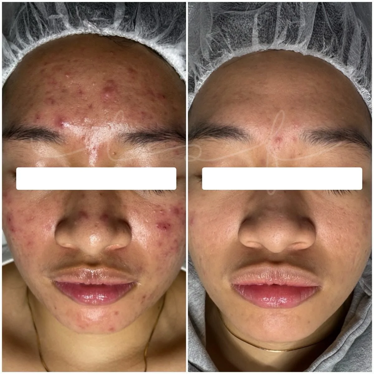 the-skin-fairy-redondo-beach-acne-studio-esthetician-skin-results-client-2.jpg