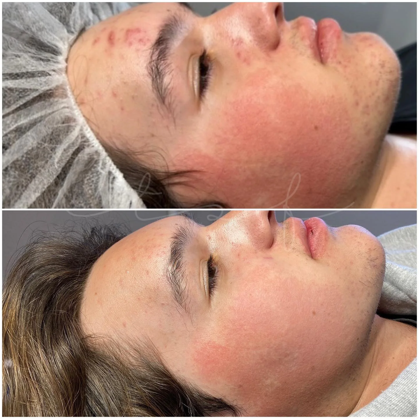 the-skin-fairy-redondo-beach-esthetician-skin-results-client-5b.jpg
