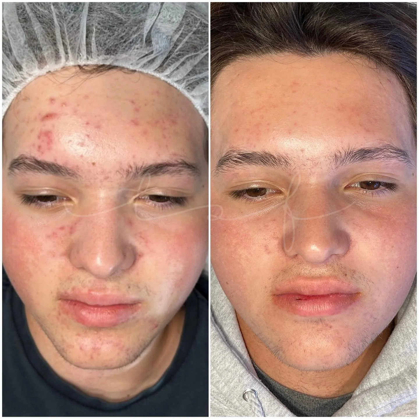 the-skin-fairy-redondo-beach-acne-studio-esthetician-skin-results-client-5a.jpg
