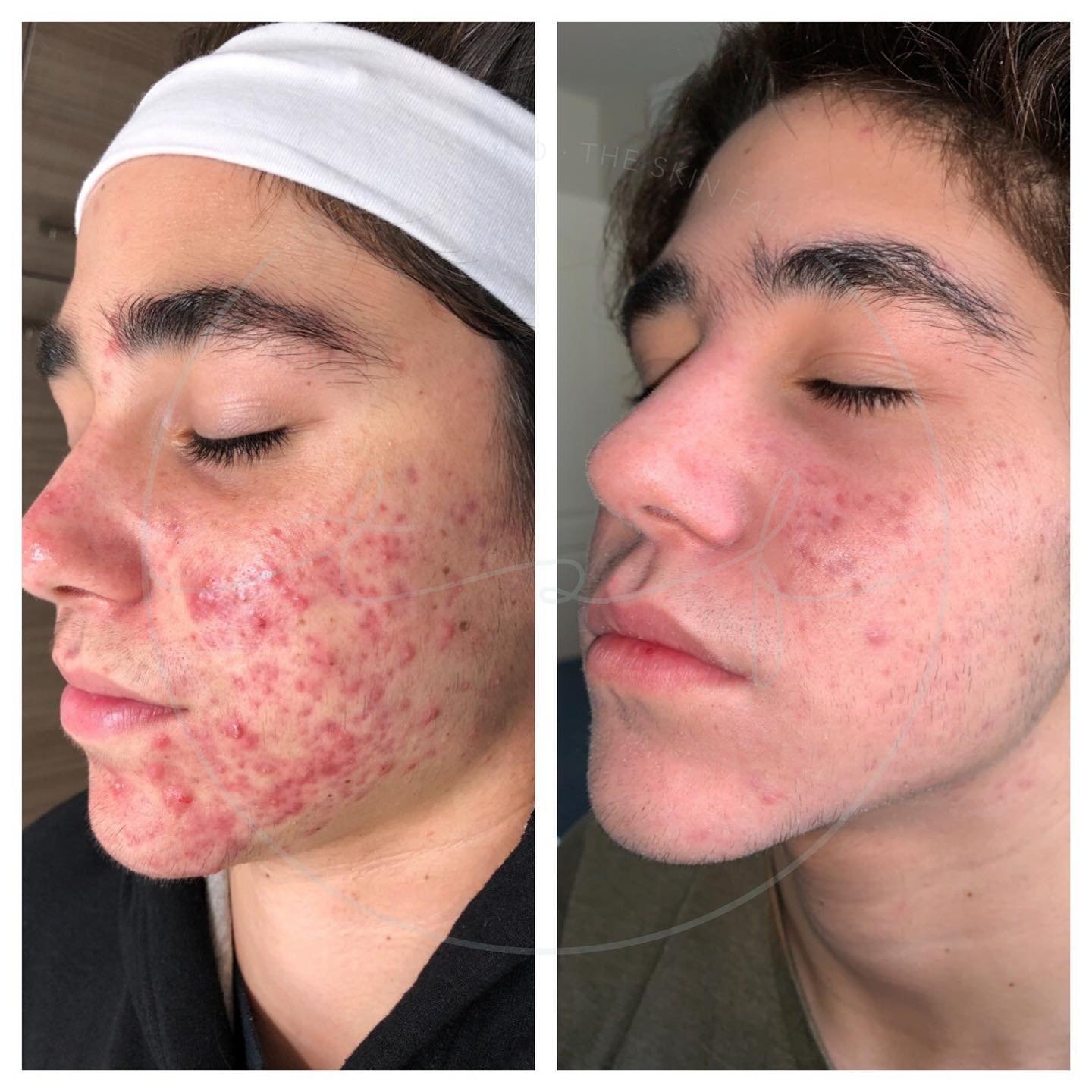 the-skin-fairy-redondo-beach-acne-studio-acne-program-results-client1b.jpg