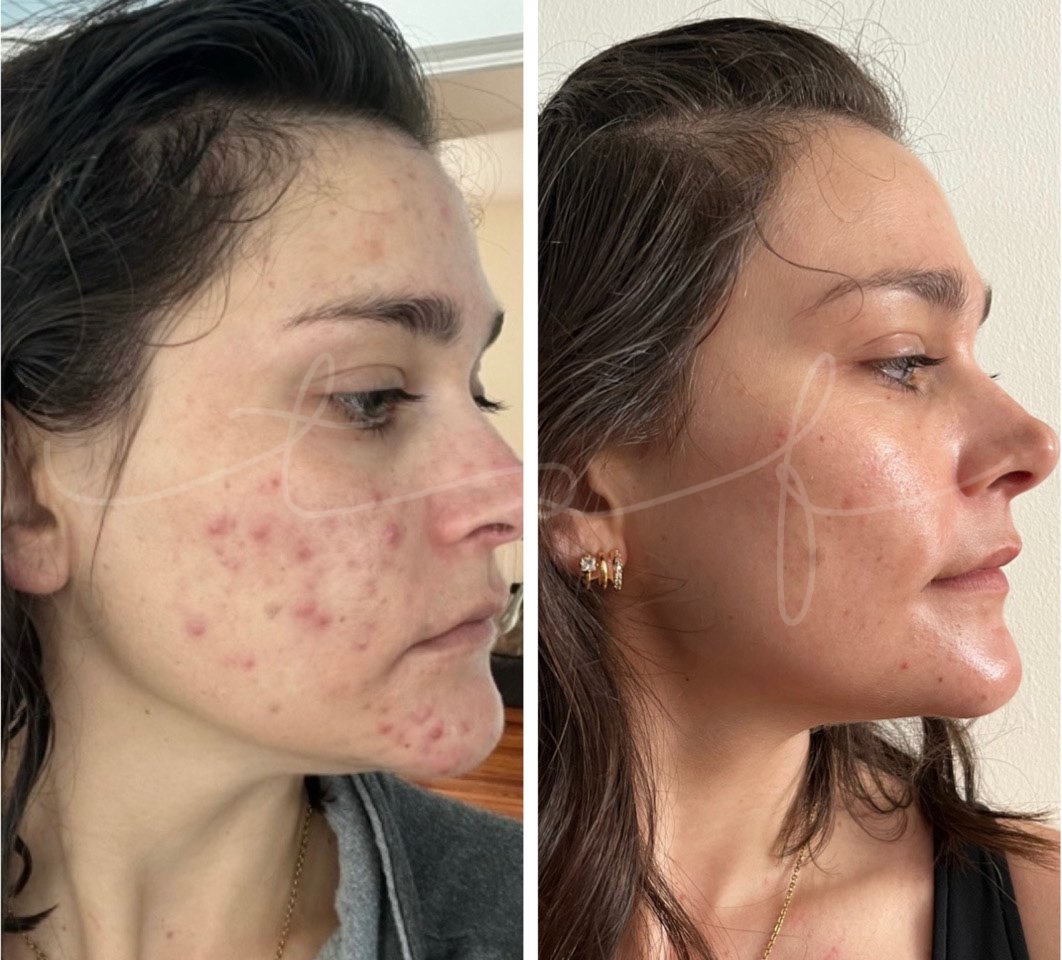 the-skin-fairy-redondo-beach-esthetician-skin-results-client-6b.jpg