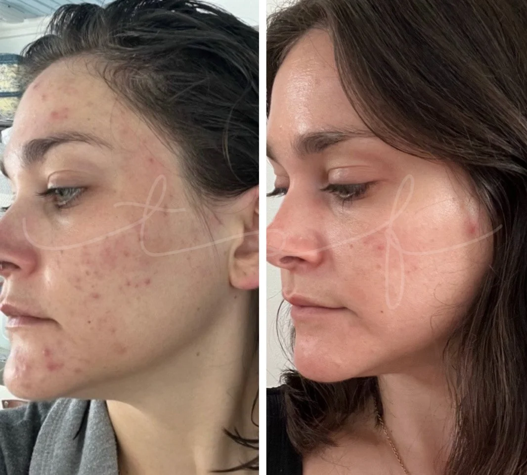 the-skin-fairy-redondo-beach-esthetician-skin-results-client-6a.jpg