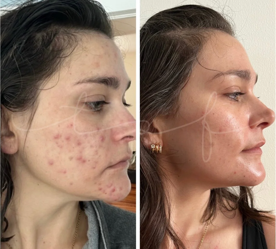 the-skin-fairy-redondo-beach-esthetician-skin-results-client-6b.jpg