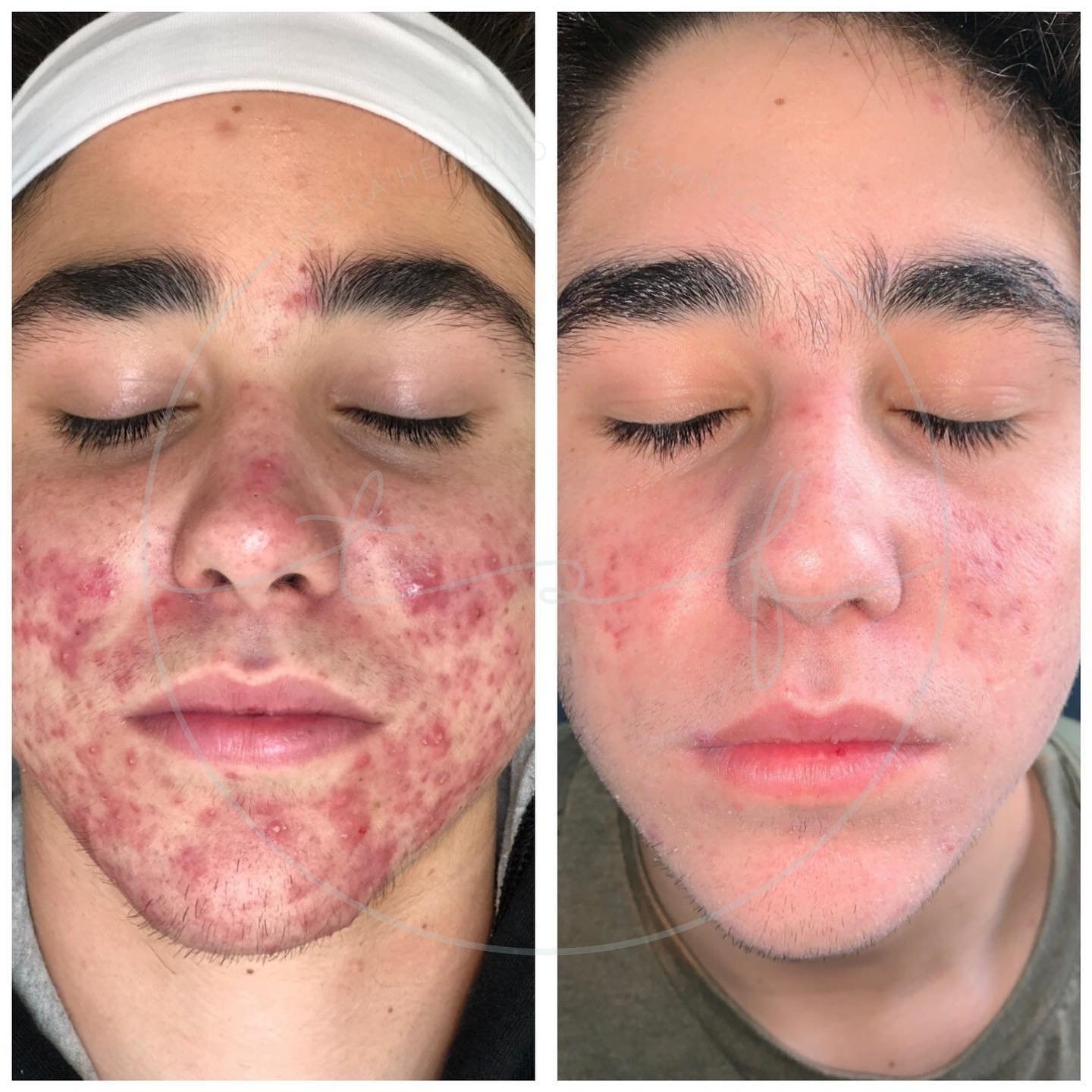 the-skin-fairy-redondo-beach-acne-studio-acne-program-results-client1a.jpg
