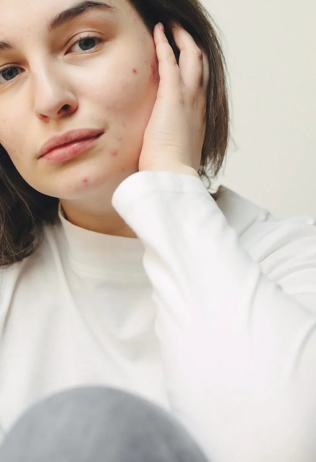 Close-up of a young woman holding her face with one hand, showing acne on her cheek and chin, wearing a white shirt.