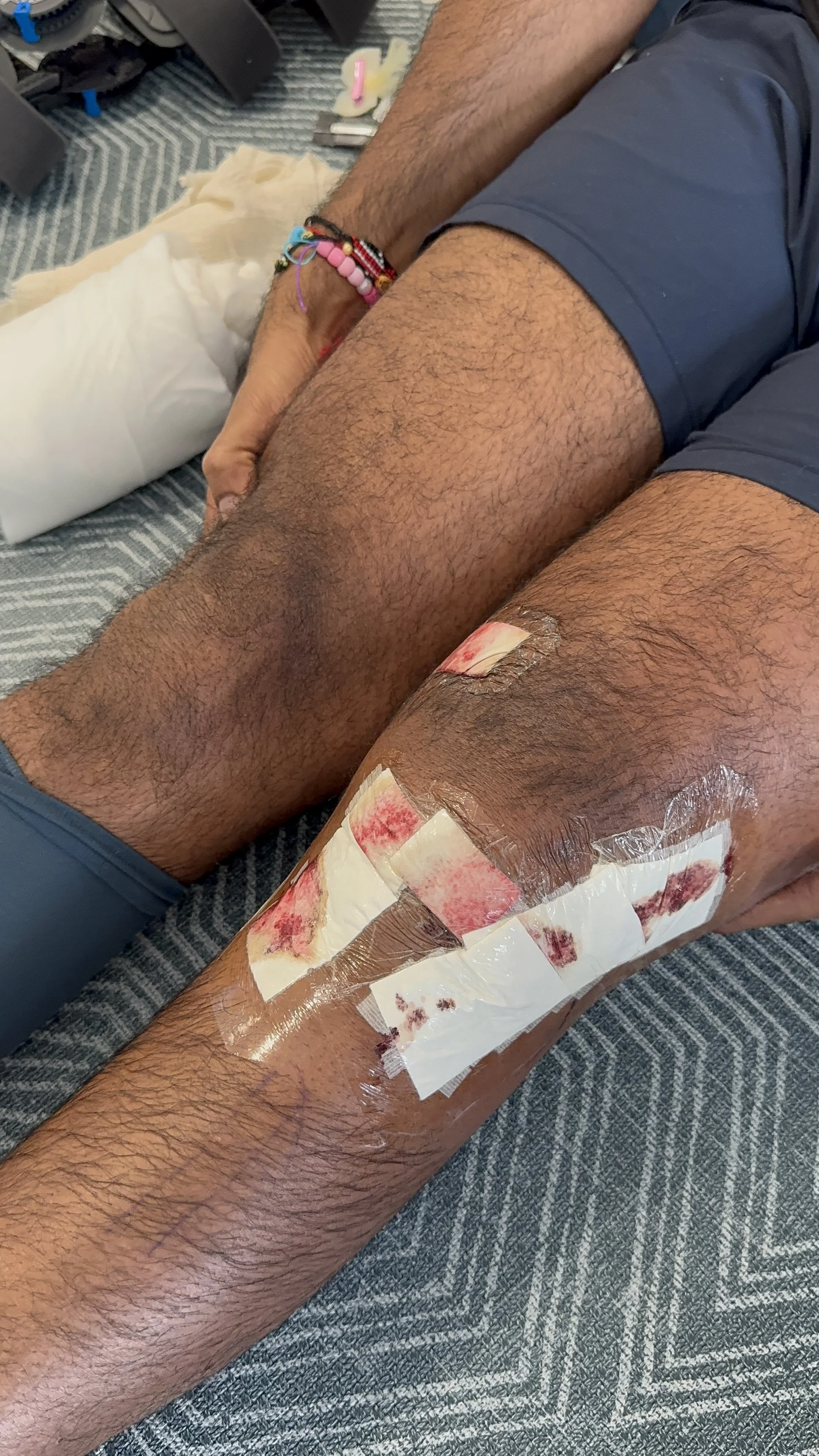 The 5 milestones that actually matter in ACL recovery