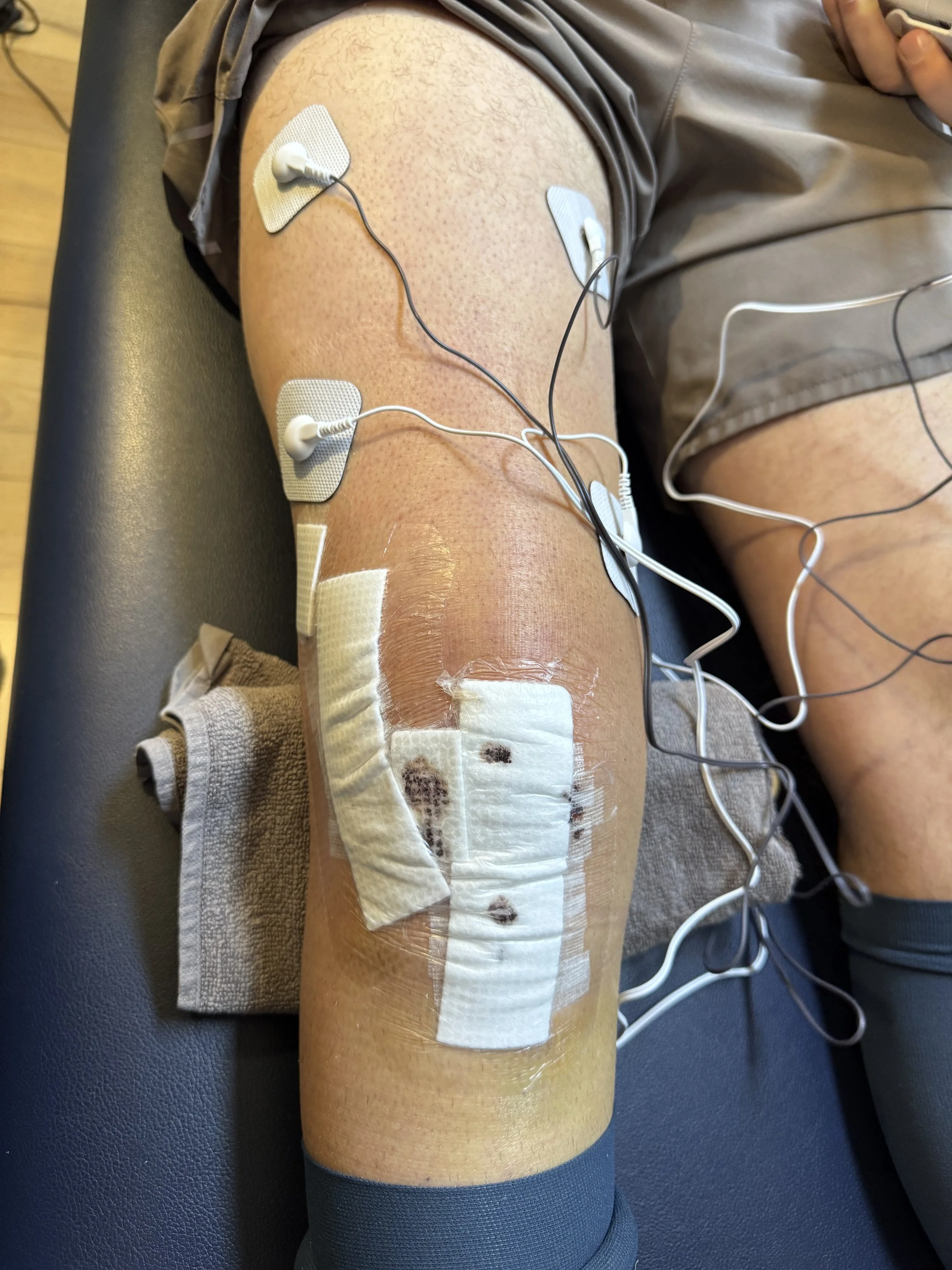 The 5 milestones that actually matter in ACL recovery