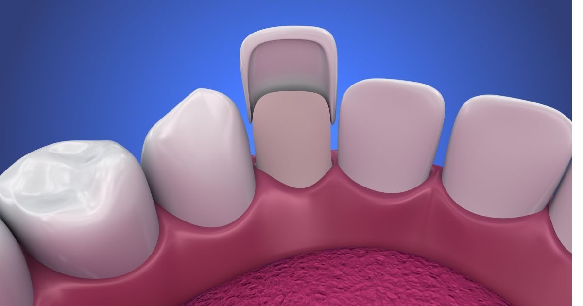How Porcelain Veneers Can Enhance Your Smile