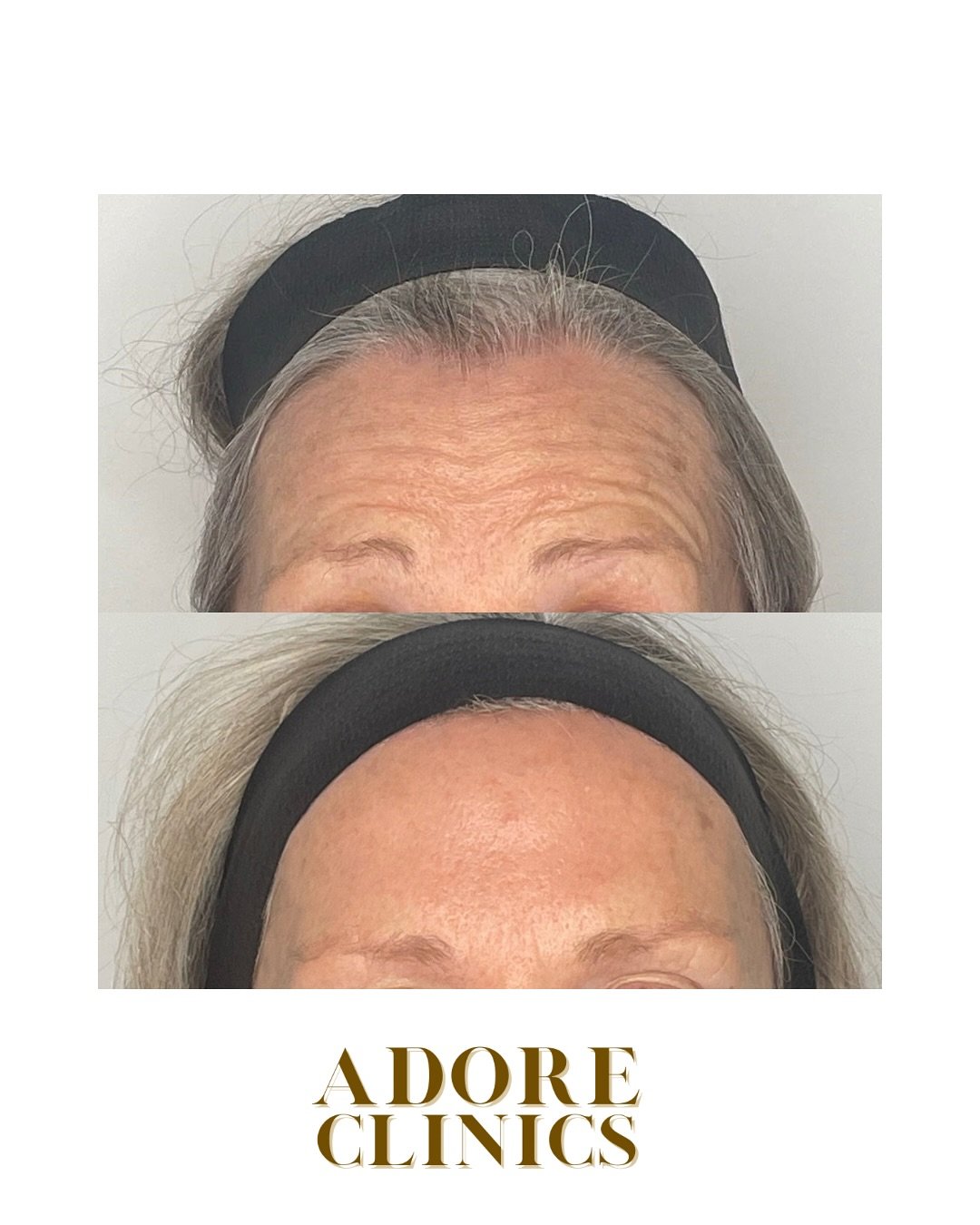 ✨The Aesthetic Eye: Precision for Delicate Skin✨

When it comes to delicate skin, precision matters. The aesthetic eye brings a refined, detail-oriented approach that prioritises subtlety, balance, and care. 

At Adore Clinics, Dr. Daniel understands