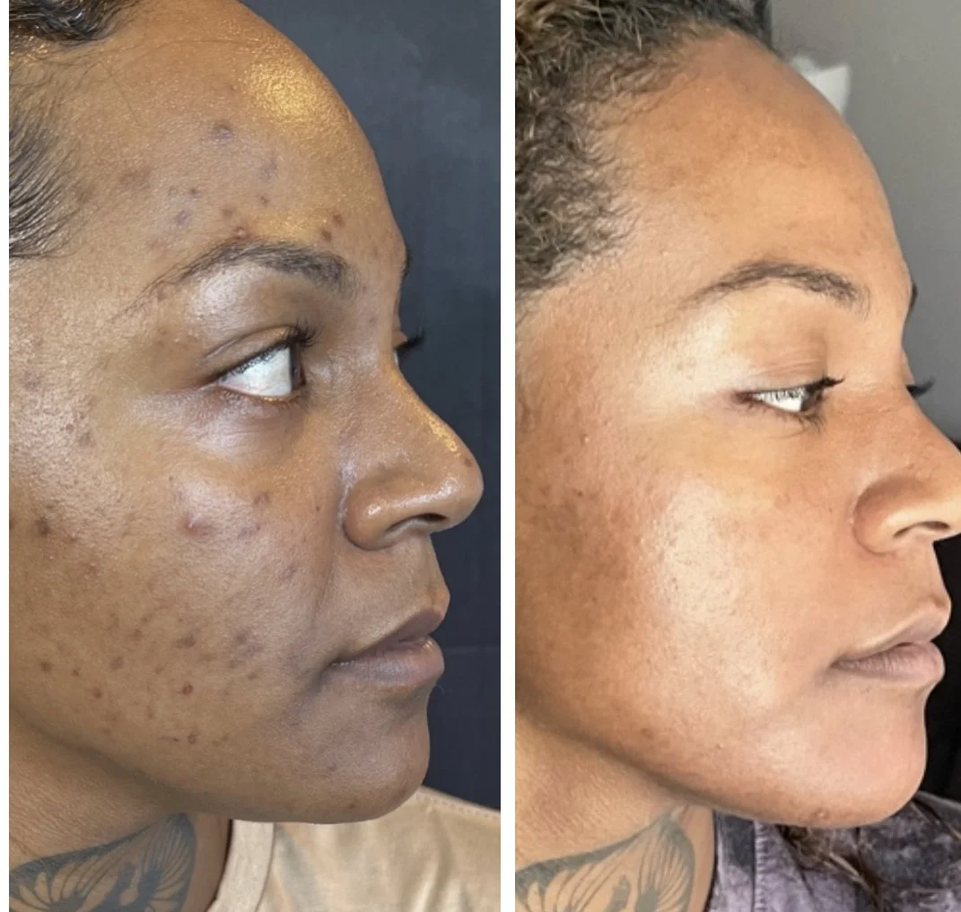 Derma Peel and Procell Microchanneling