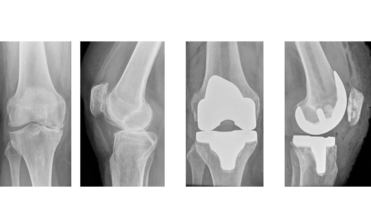 Knee Unit Types Types of Knee Replacement — Mr Murali Krishnan | Specialist Hip and ...