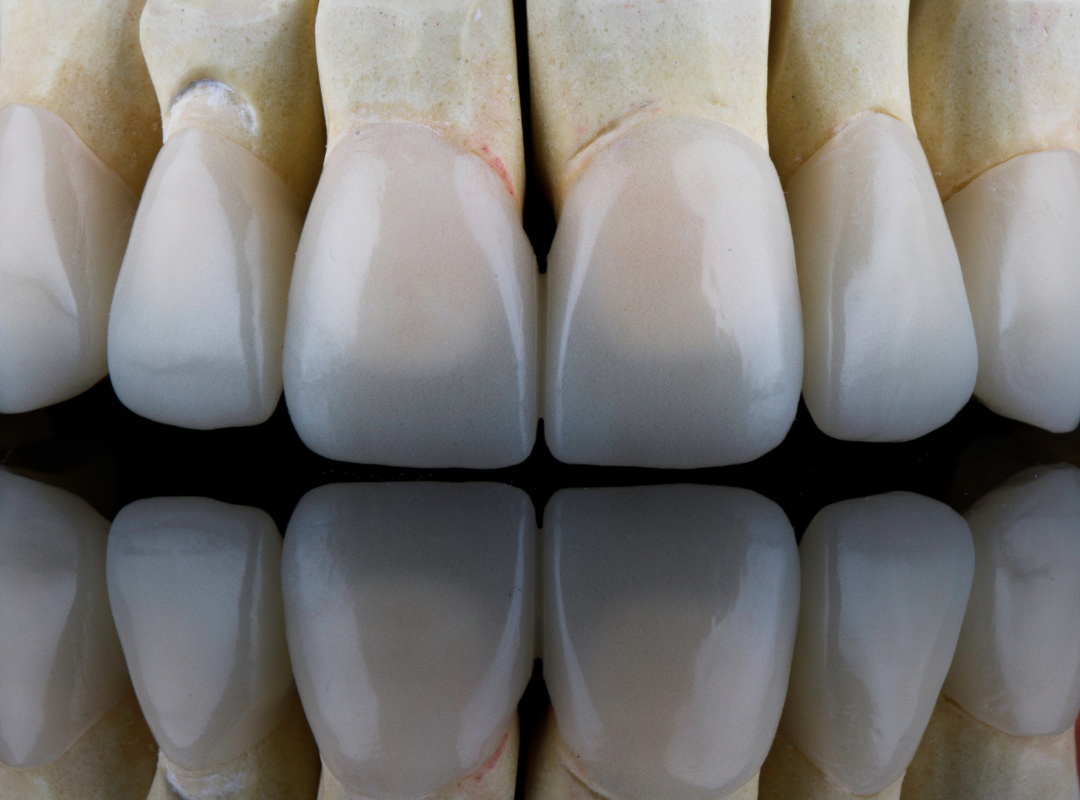 Why Understanding Occlusion and TMJ is critical to successful Cosmetic Dentistry