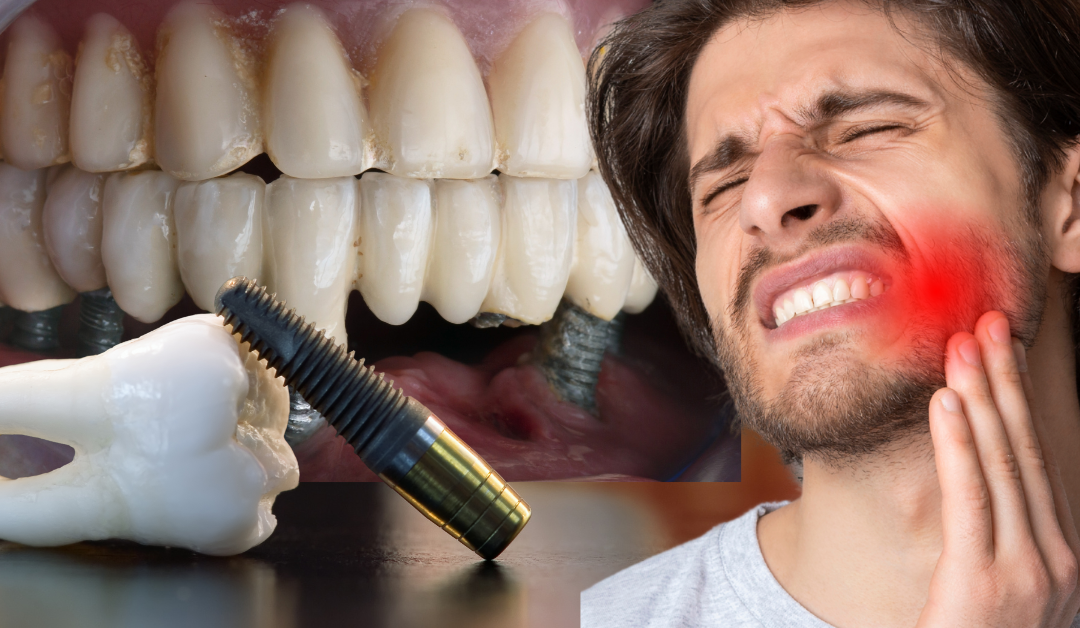 From Bruxers to Bone Loss: Occlusion as the Hidden Variable in Implant Complications