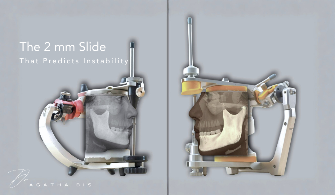 The 2 mm Slide That Predicts Instability