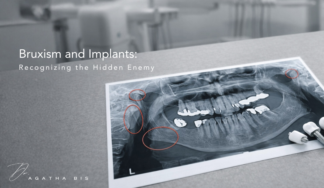 Bruxism and Implants