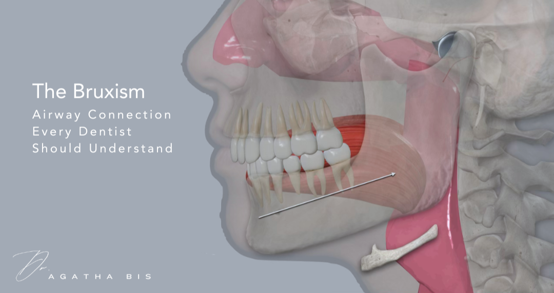 The Bruxism - Airway Connection Every Dentist Should Understand