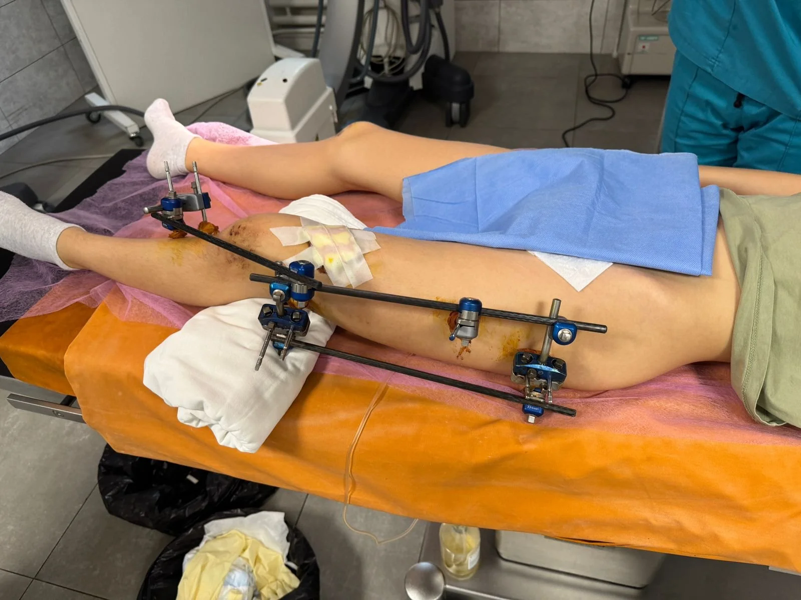 A 13-year old girl is getting her complex femoral fracture fixed with our external fixators.