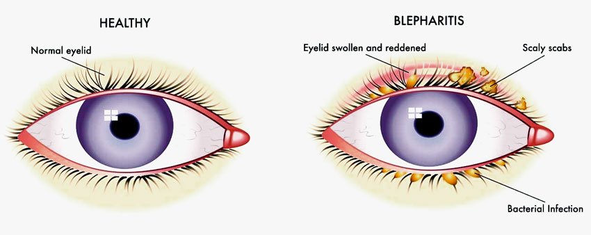 Demodex Blepharitis: Understanding and Overcoming