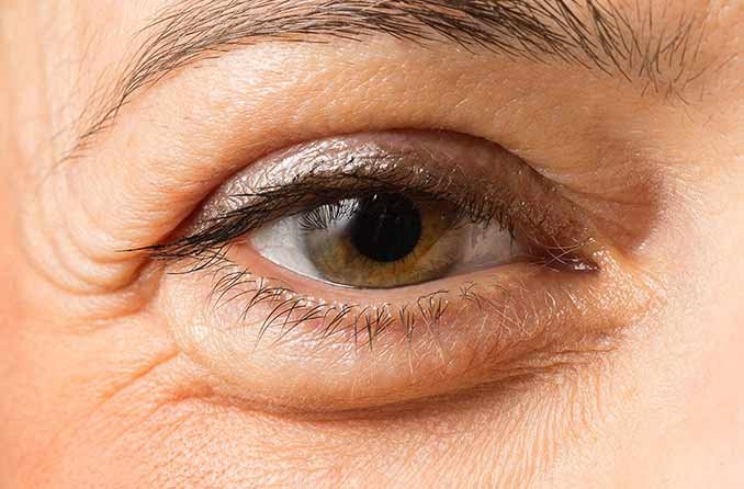 Say Goodbye to Puffy Eyes