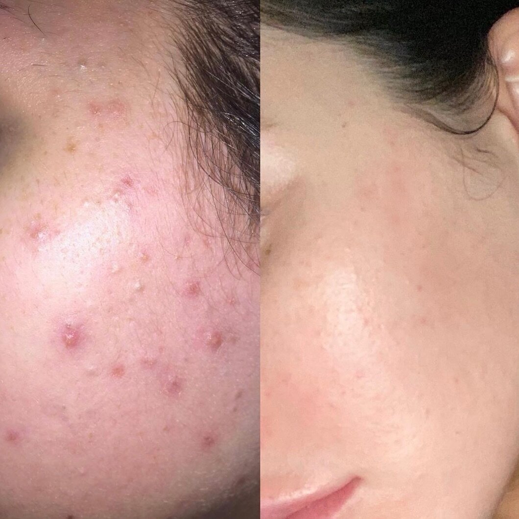 MK acne revision ✨

I begin each MK facial with an intentional consultation so I can treat your goals and tailor a bespoke treatment specifically to you. 
Included in the MK signature facial is a luxury double cleanse, microdermabrasion, exfoliation,