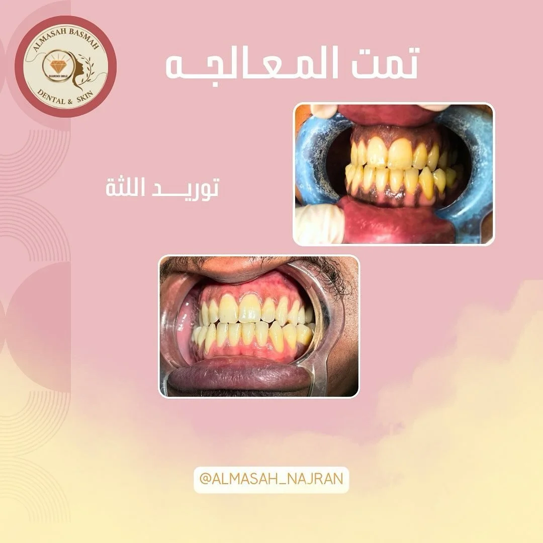 التوريد بجهاز الليزر الحديث 👌💎💎💎 ابتسم بثقه 

#من_زانت_اسنانه_زانت_حياته #هاشتاق #وزارة_الصحة 

.
#زينها_وعيش🌙💎🩷
.
&rlm;.#najran#trending #for#مدارس#دعم#مشاركه#ترند#اكسبلور#منصة_مدرسة #نور#السعودية #الخليج#الجنوب#نجران#نجران_الان #بنات_نجران #