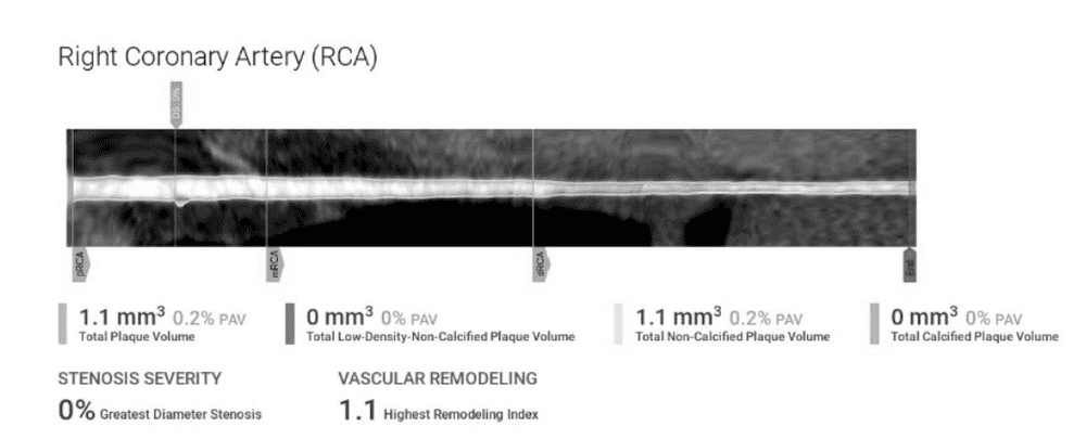 Kayla-Barnes-Lentz-Right-Coronary-Artery-Results.png