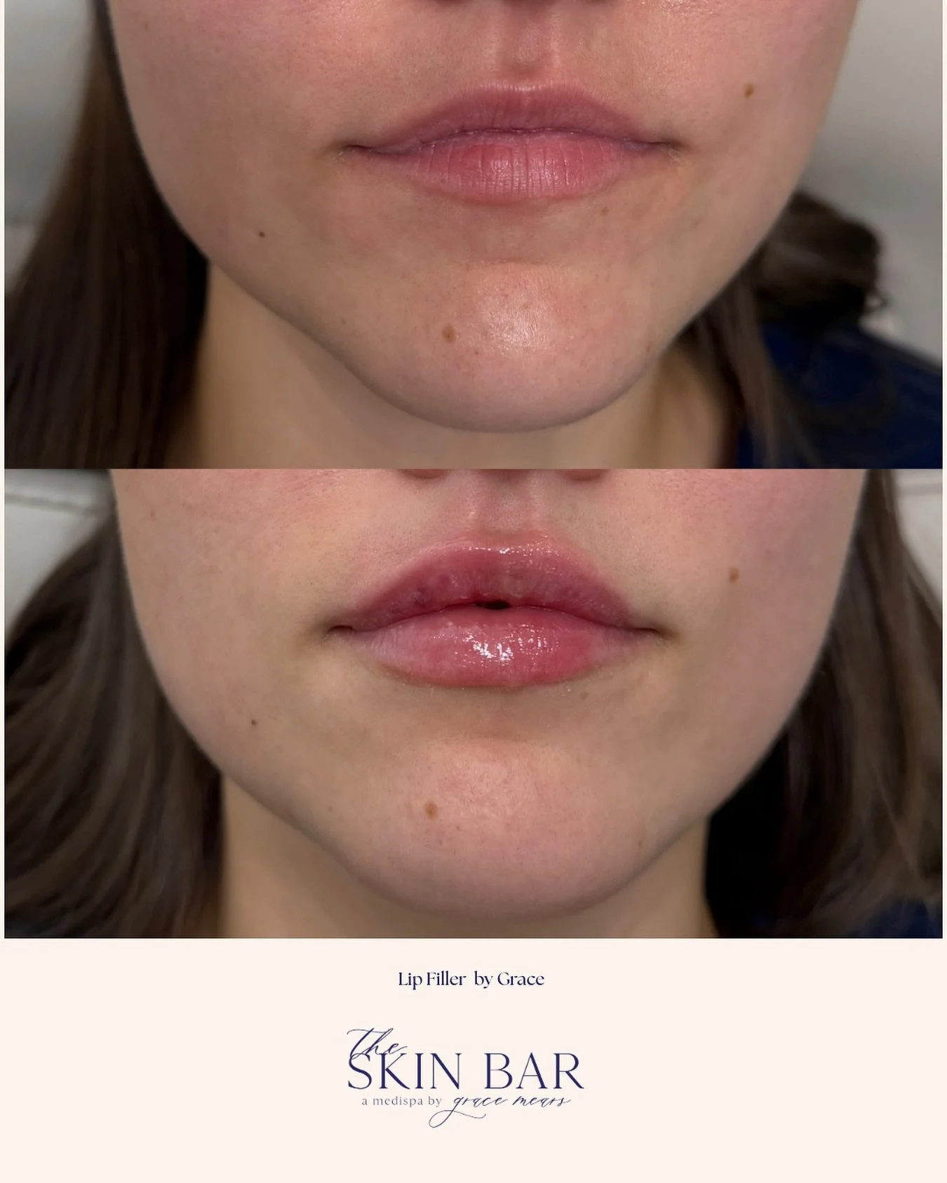 Subtle symmetry, perfected 💋
We corrected natural asymmetries and built her shape gradually over two sessions for the most balanced, beautiful lips.

Book your lip filler treatment now to have beautiful lips before the holidays! Link in bio to book!