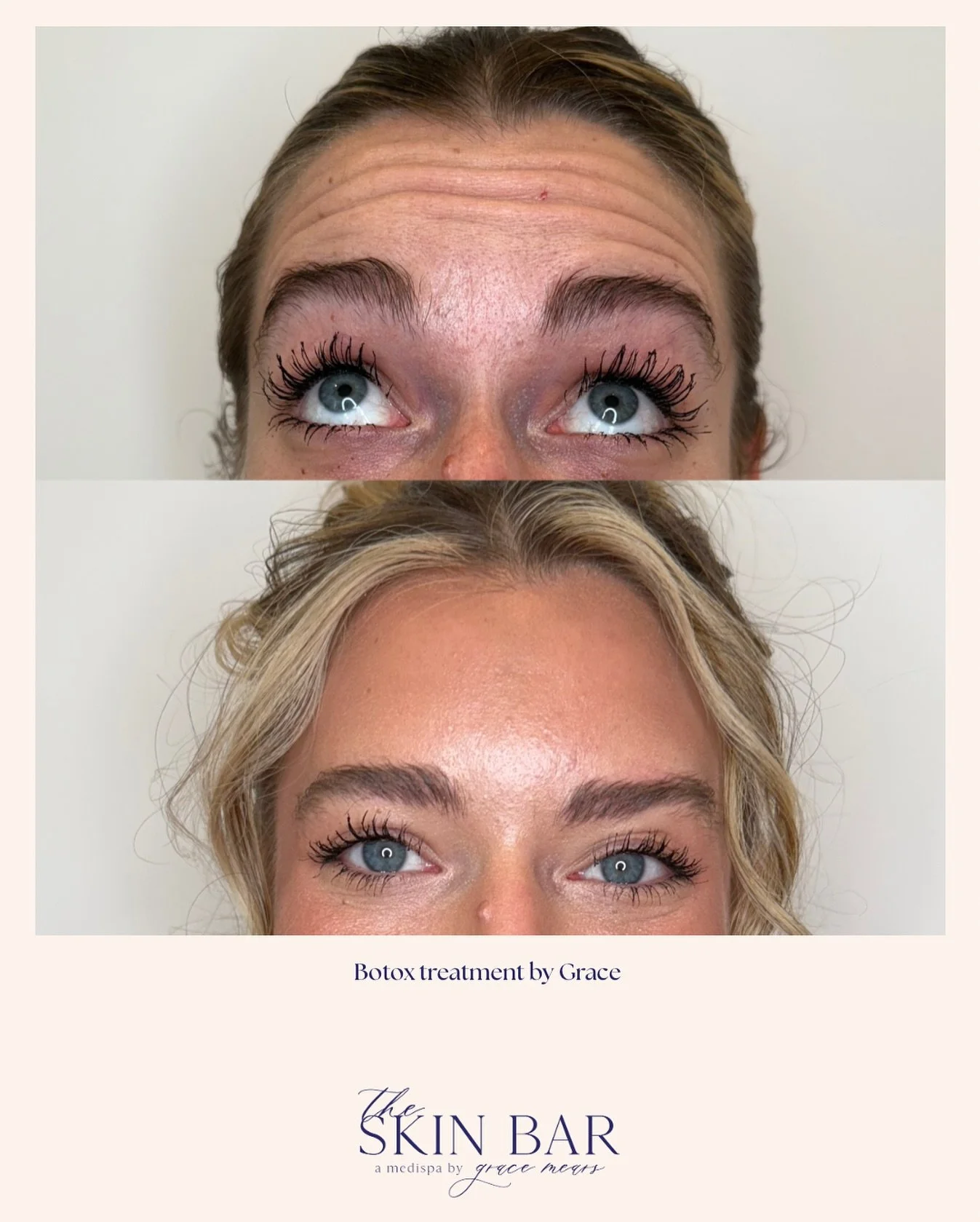 Confidence looks good on you 👏
A little Botox can go a long way&hellip; and we&rsquo;re here for it.

$10/unit BOO-tox &rarr; next week only!
Very limited appointment spots.
Tap the link in bio or call/text 865-323-6073 to claim yours.