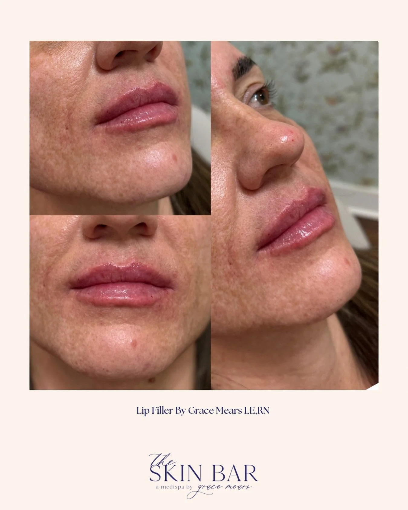 New year, new lips ✨
Subtle enhancement, balanced shape, and a hydrated finish! 

Book your lip appointment today by clicking the link in our bio! 🎉🥰💋