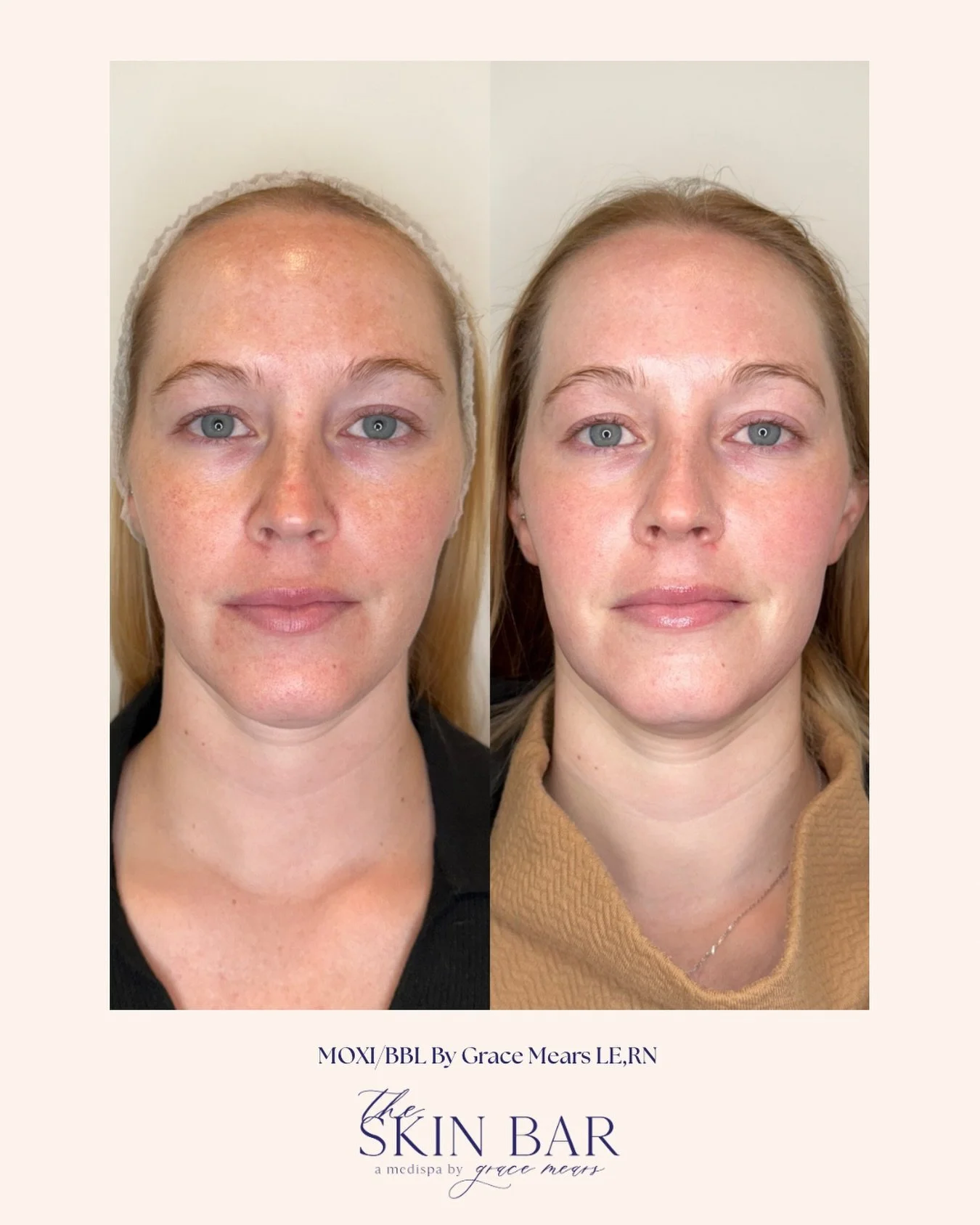 Only ONE BBL/MOXI to give this gorgeous glow! 
MOXI for texture + collagen.
BBL for redness, pigment, and overall tone.
When combined = clear, even, glowing skin 🤍
Results you can see, skin health you can feel.