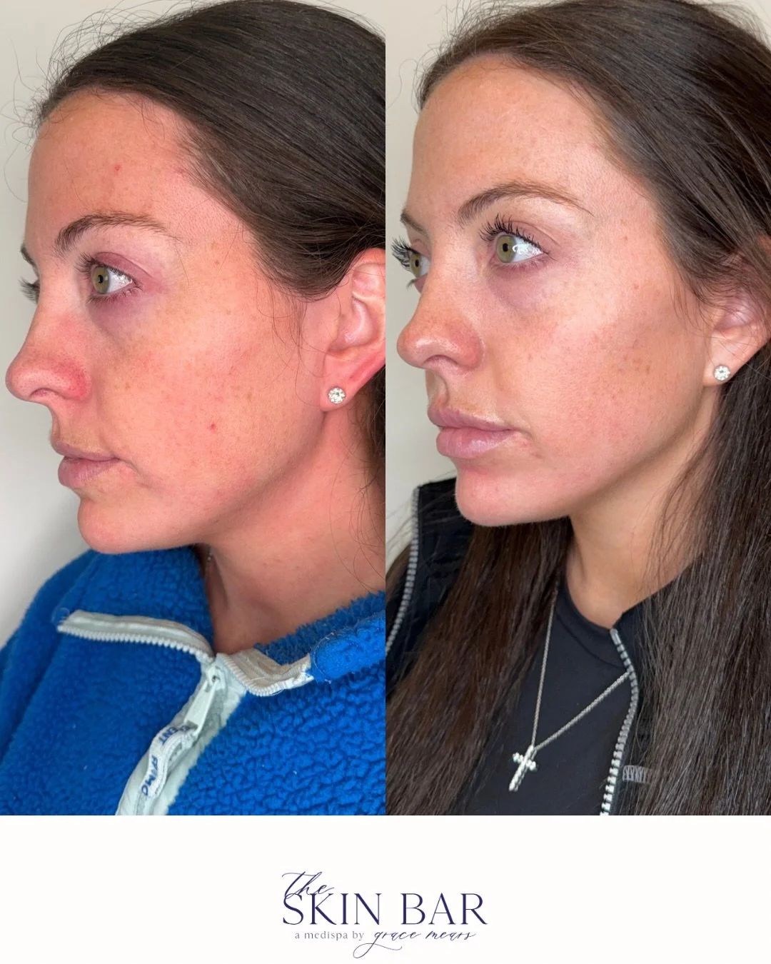 Facial Rebalancing with filler by Grace at The Skin Bar ✨
2 weeks from before to after. 
Targeted Botox.
Medical-grade skincare.

Notice the improved brow support, smoother under-eye transition, and refined skin quality.

Facial harmony > frozen f