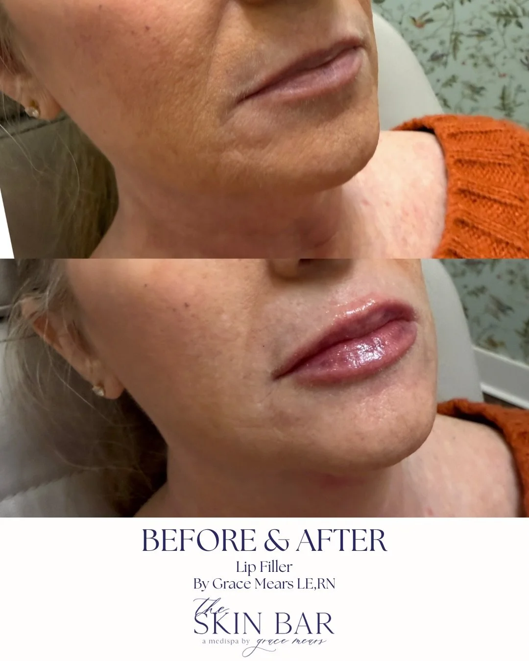 Aging lips lose collagen and hydration that&rsquo;s where filler comes in.
Strategic placement restores structure, boosts hydration, and smooths those tiny lines that give age away.💉✨