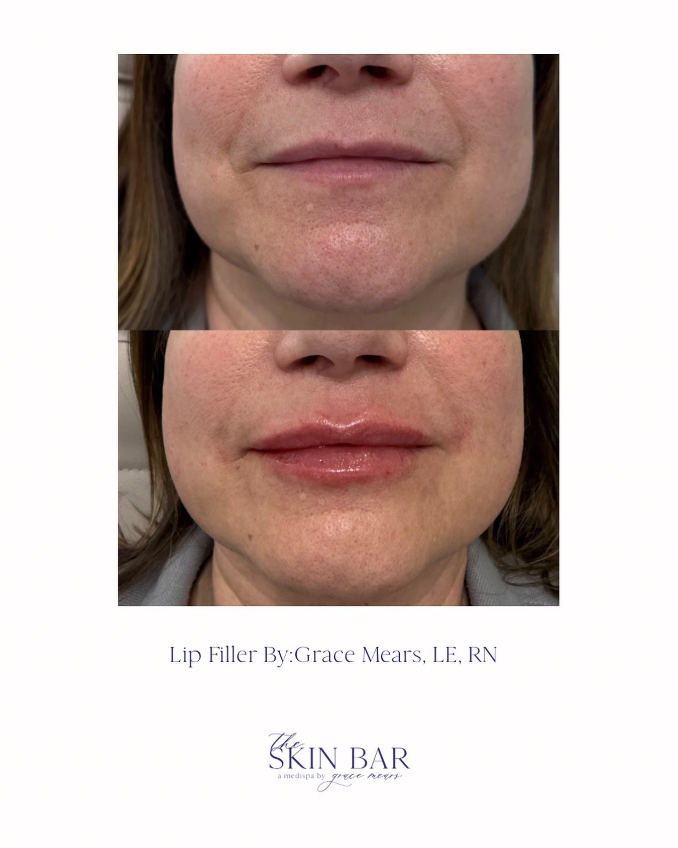 Crisp border, soft volume, and lips that still look like you 💋

This is your reminder that filler doesn&rsquo;t have to look &ldquo;done.&rdquo; We focused on defining the lip border while keeping the body smooth, hydrated, and natural.

Subtle. Bal