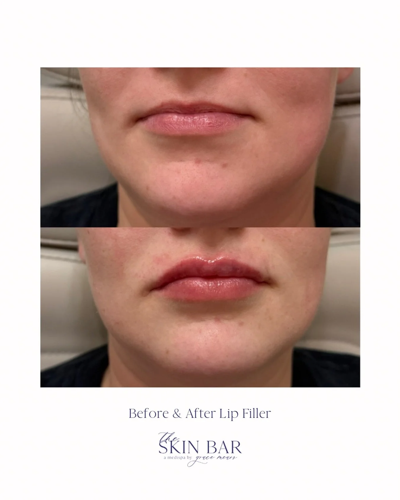 Subtle enhancement. Balanced shape. Still you, just with a little extra confidence. 💋✨

At  The Skin Bar⁠￼ we focus on lips that fit your face, enhance your natural features, and heal beautifully. No overfilling. No trends. Just customized, soft vol