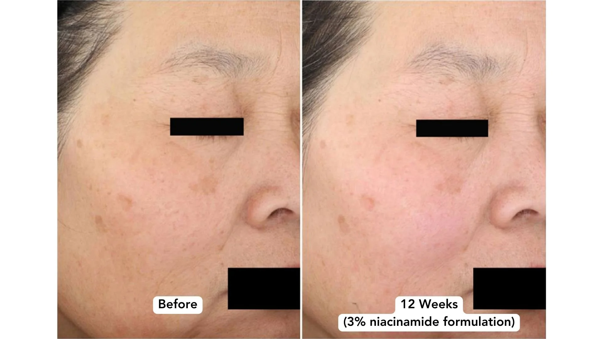 Dermatologist Reviews: Anua Dark Spot Correcting Serum