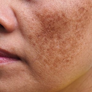 Pigment 101: Understanding Dark Spots and How to Treat Them