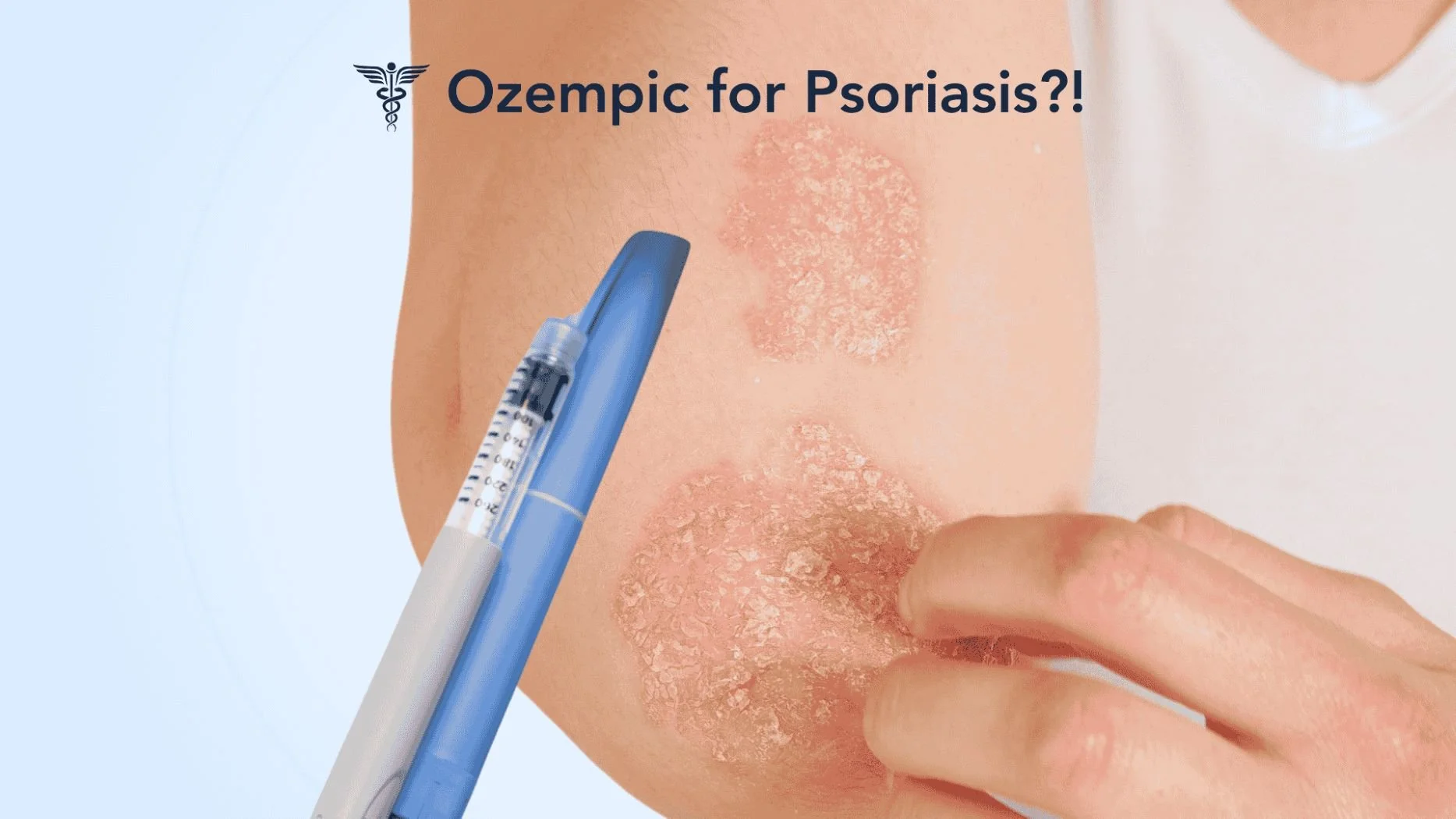 Ozempic for Psoriasis: A Dermatologist’s Thoughts