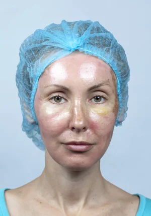 Day by Day Halo Laser Recovery Pictures