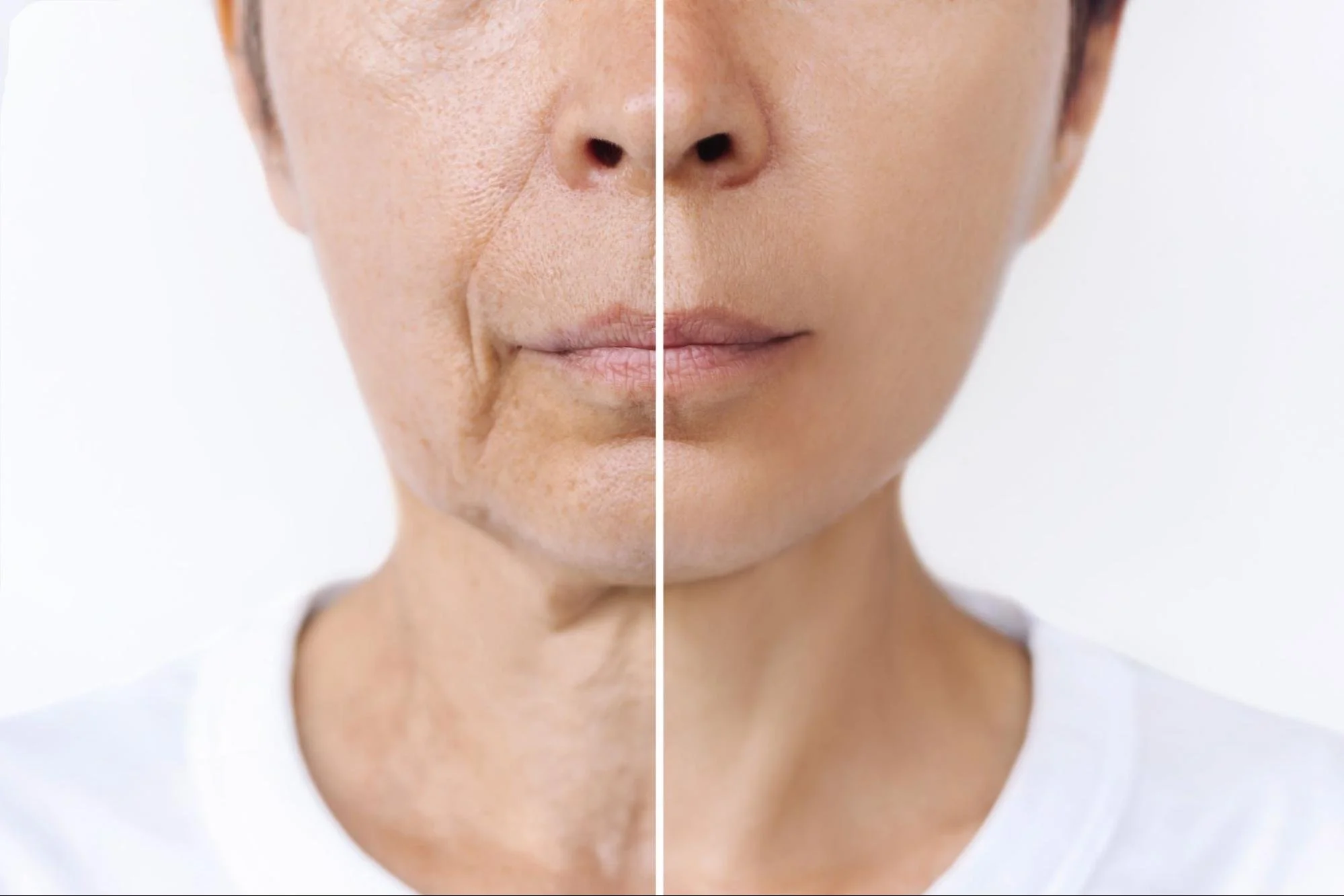 What Happens to the Lower Face as We Age?