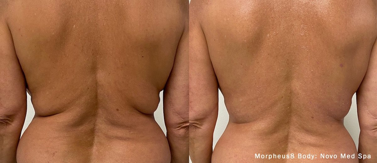 Morpheus8 Body Treatment in Bluffton, South Carolina at Revive Palmetto