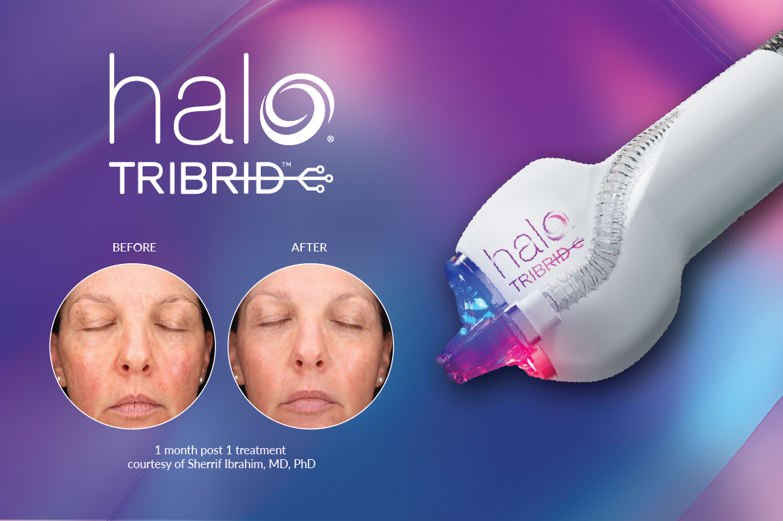 HALO Sciton Tribrid at Revive Palmetto Aesthetics & Plastic Surgery in Bluffton, South Carolina