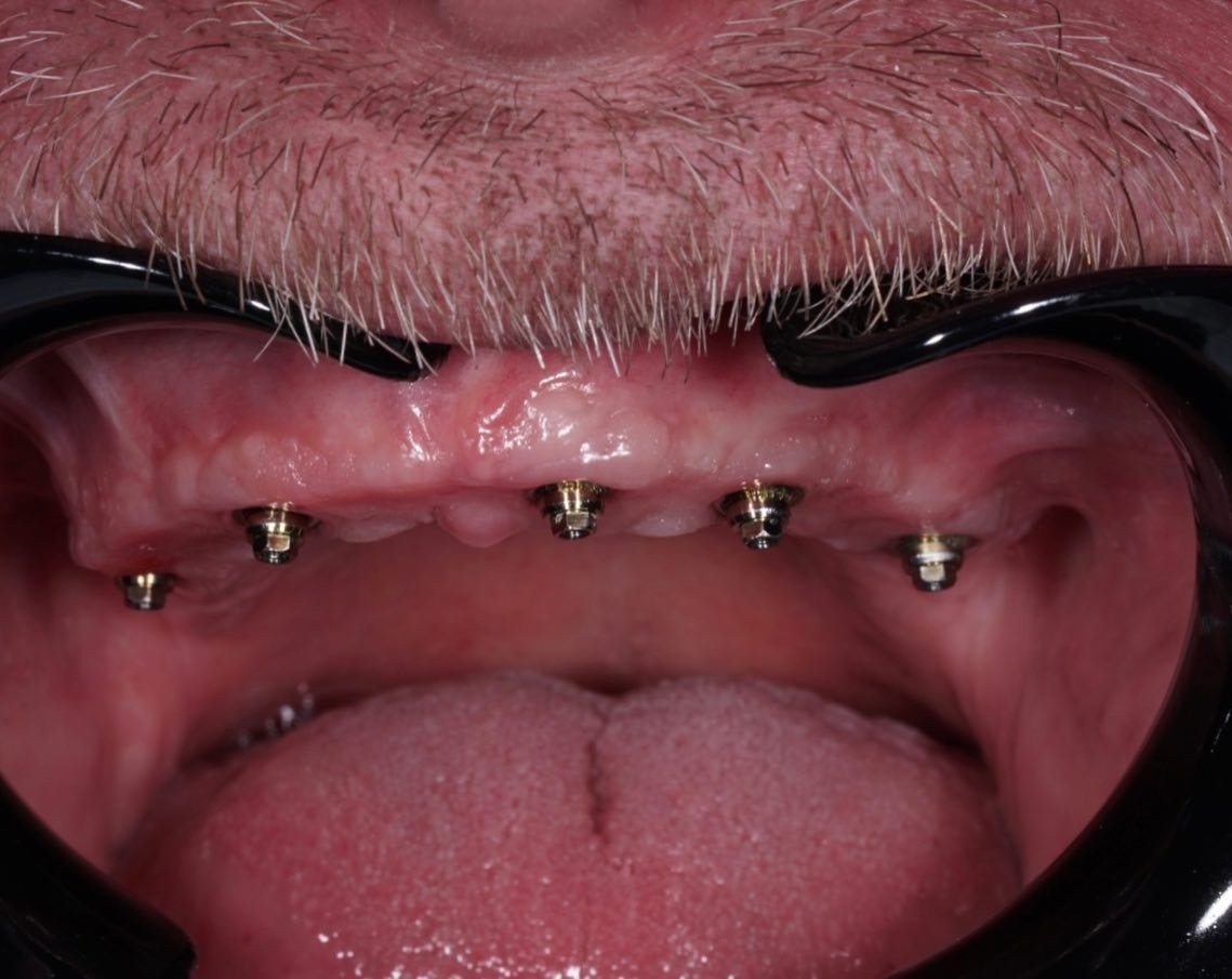 There goes a monolithic zirconia FP3

#allonx #torontoimplantdentistry #implantdentistry
