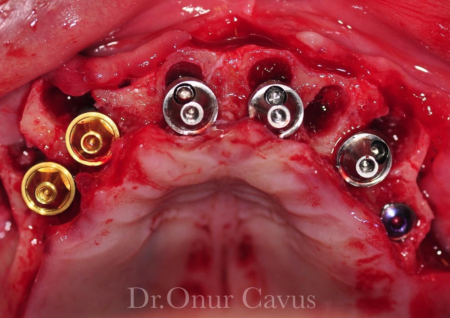 This one goes for the #fullarchfriday 
#allon6 case before socket grafting and temporarization
#dronurcavus 
#dentistryworld #torontodentist #dentalimplants #dentalimplantology #dentisttoronto #implantology #implantdentistry #implantologia  #dentist
